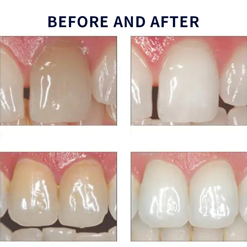 Opalescence Whitening 20% PF 2 - đánh giá và giá Teeth Whitening Hismile