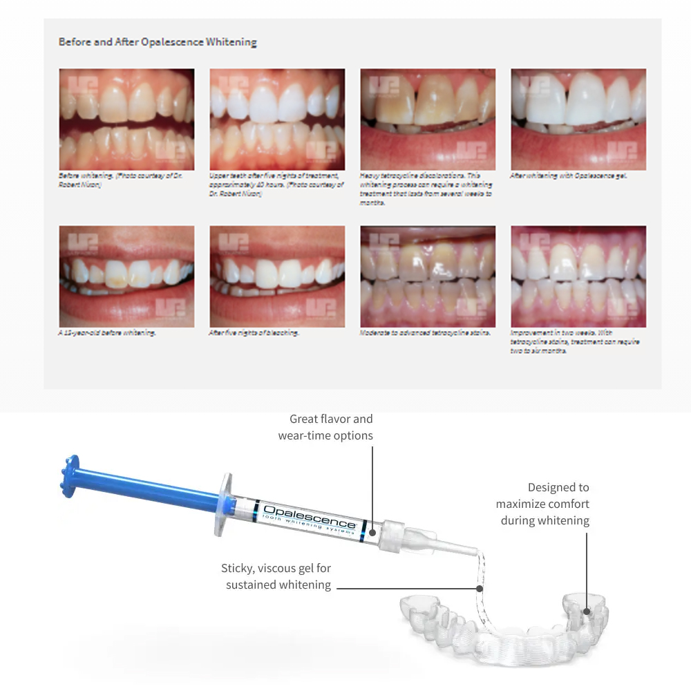 Opalescence Whitening 20% PF 2 - đánh giá và giá Teeth Whitening Hismile