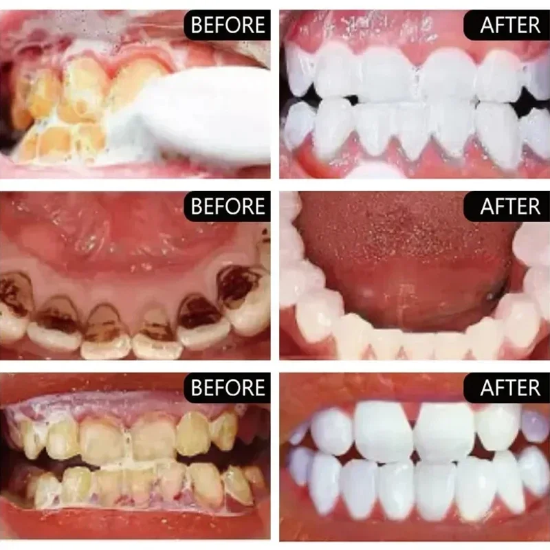 Fast Remove Smoke Stains Tooth - đánh giá và giá Teeth Whitening Fast