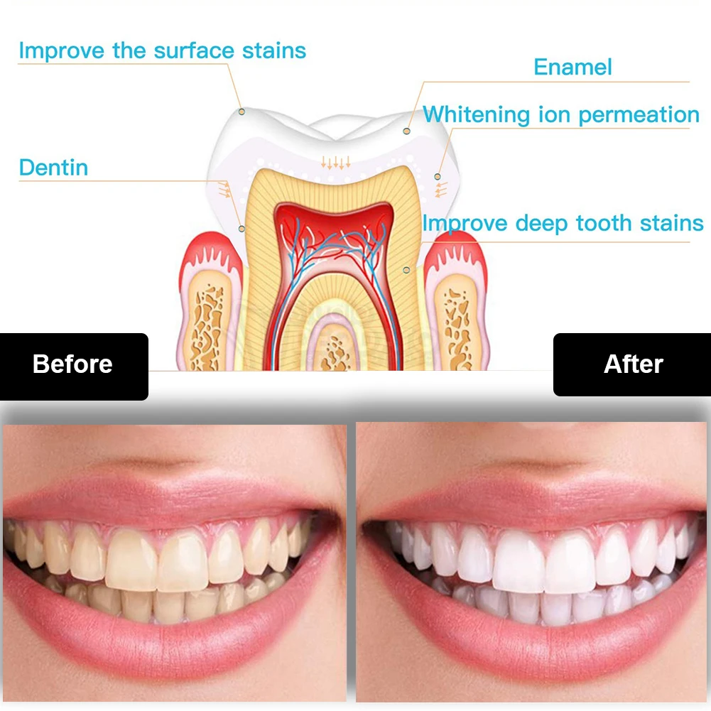 Dental Teeth Whitening Kit Min - đánh giá và giá Teeth Whitening Hismile